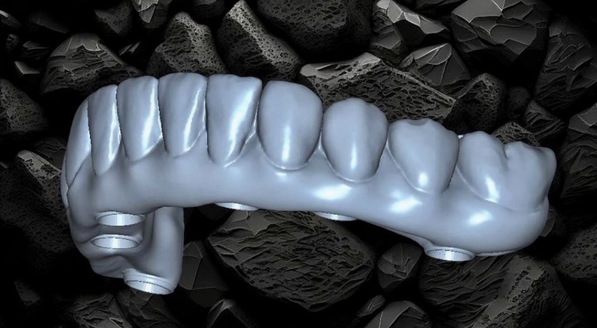 Estructura atornillada sobre implantes