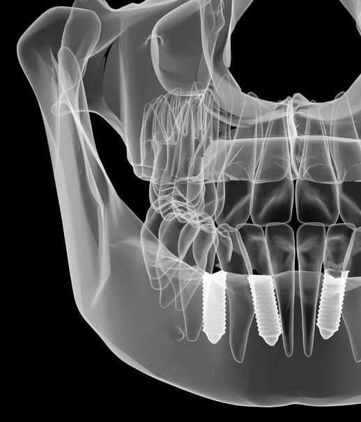 Radiografía con tres implantes en el maxilar inferior
